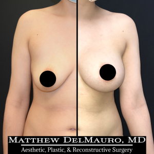 Before-After-6.5-Months-–-Breast-Lift-Circumareolar-with-Implants-Silicone1