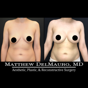 Before-After-6.5-Months-–-Breast-Lift-Circumareolar-with-Implants-Silicone3
