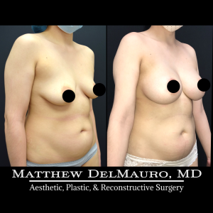 Before-After-6.5-Months-–-Breast-Lift-Circumareolar-with-Implants-Silicone4
