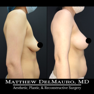 Before-After-6.5-Months-–-Breast-Lift-Circumareolar-with-Implants-Silicone5