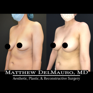 Before-After-6.5-Months-–-Breast-Lift-Circumareolar-with-Implants-Silicone6