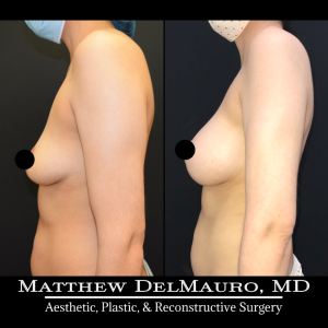 Before-After-6.5-Months-–-Breast-Lift-Circumareolar-with-Implants-Silicone7
