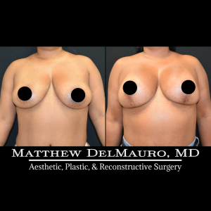 Before-After-9-Months-–-Breast-Lift-Inverted-T-with-Implants-Silicone1