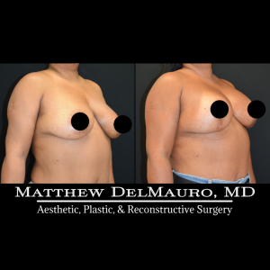 Before-After-9-Months-–-Breast-Lift-Inverted-T-with-Implants-Silicone2
