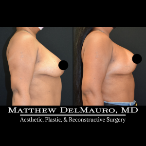 Before-After-9-Months-–-Breast-Lift-Inverted-T-with-Implants-Silicone3