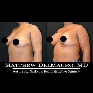 Before-After-9-Months-–-Breast-Lift-Inverted-T-with-Implants-Silicone4