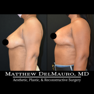 Before-After-9-Months-–-Breast-Lift-Inverted-T-with-Implants-Silicone5