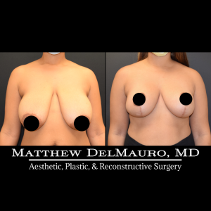 Before-After-9-Months-–-Breast-Lift1