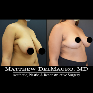 Before-After-9-Months-–-Breast-Lift2