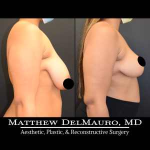 Before-After-9-Months-–-Breast-Lift3