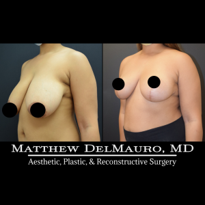 Before-After-9-Months-–-Breast-Lift4
