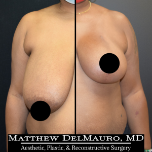 Before-After-2-Months-–-Breast-Reduction-Inverted-T-Superomedial-Pedicle1