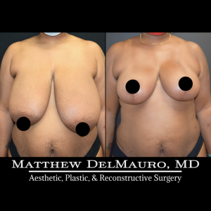 Before-After-2-Months-–-Breast-Reduction-Inverted-T-Superomedial-Pedicle2