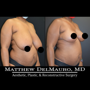 Before-After-2-Months-–-Breast-Reduction-Inverted-T-Superomedial-Pedicle3