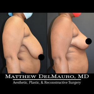Before-After-2-Months-–-Breast-Reduction-Inverted-T-Superomedial-Pedicle4