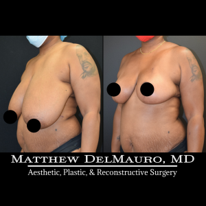 Before-After-2-Months-–-Breast-Reduction-Inverted-T-Superomedial-Pedicle5