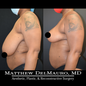 Before-After-2-Months-–-Breast-Reduction-Inverted-T-Superomedial-Pedicle6