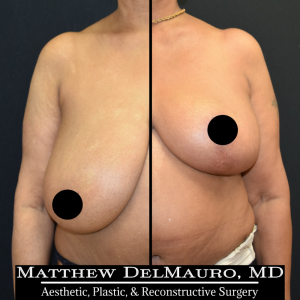 Before-After-3-Months-–-Breast-Reduction1