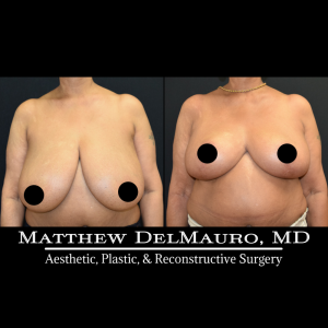 Before-After-3-Months-–-Breast-Reduction2