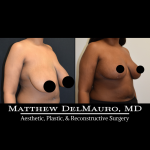 Before-After-3-Months-–-Breast-Reduction3