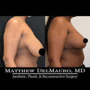 Before-After-3-Months-–-Breast-Reduction4