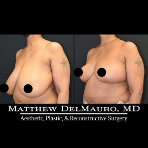 Before-After-3-Months-–-Breast-Reduction5