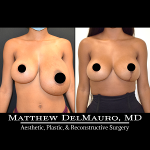 Before-After-4-Months-–-Bilateral-Implant-Exchange-Bilateral-Capsule-Revision-Left-Breast-Reduction-History-of-Bilateral-Breast-Augmentation1