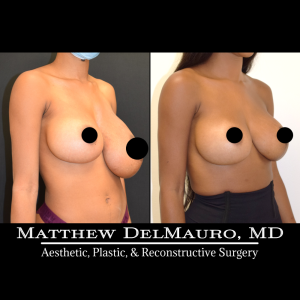 Before-After-4-Months-–-Bilateral-Implant-Exchange-Bilateral-Capsule-Revision-Left-Breast-Reduction-History-of-Bilateral-Breast-Augmentation2