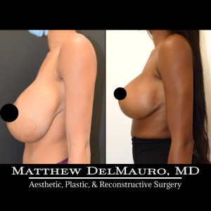 Before-After-4-Months-–-Bilateral-Implant-Exchange-Bilateral-Capsule-Revision-Left-Breast-Reduction-History-of-Bilateral-Breast-Augmentation5