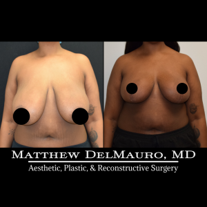 P5-Before-After-3-Months-–-Breast-Reduction2