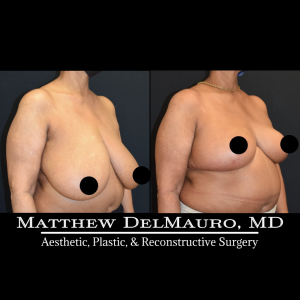 P5-Before-After-3-Months-–-Breast-Reduction3