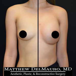 Before-After-10-Months-–-Revision-Breast-Augmentation-Silicone1