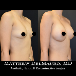 Before-After-10-Months-–-Revision-Breast-Augmentation-Silicone2