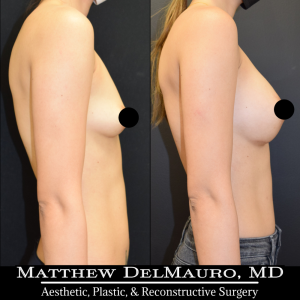 Before-After-10-Months-–-Revision-Breast-Augmentation-Silicone3