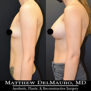 Before-After-10-Months-–-Revision-Breast-Augmentation-Silicone5