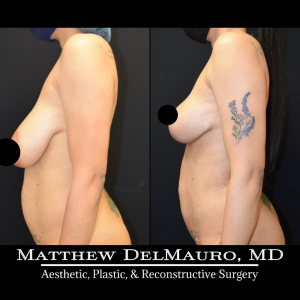 Before-After-3.5-Months-–-Breast-Lift-Liposuction-of-the-Abdomen-Flanks-Abdominal-Scar-Revision5