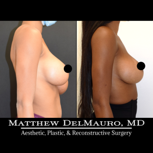 Before-After-4-Months-–-Bilateral-Implant-Exchange-Bilateral-Capsule-Revision-Left-Breast-Reduction-History-of-Bilateral-Breast-Augmentation3