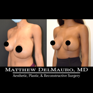 Before-After-4-Months-–-Bilateral-Implant-Exchange-Bilateral-Capsule-Revision-Left-Breast-Reduction-History-of-Bilateral-Breast-Augmentation4
