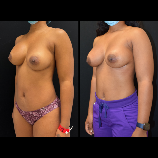 capsular-contracture-breast-implant-revision-plastic-surgery-nyc-before-after-ak-patient-1-3