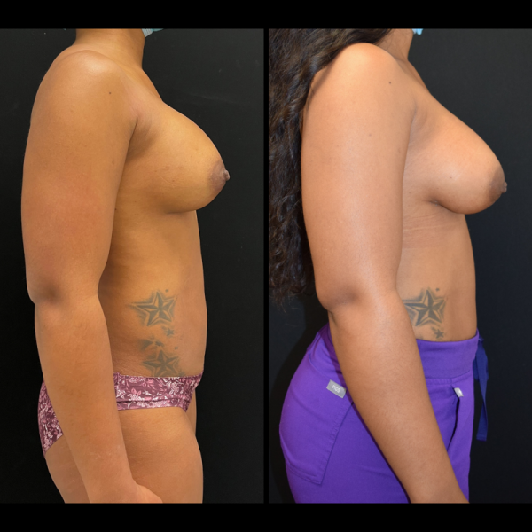 capsular-contracture-breast-implant-revision-plastic-surgery-nyc-before-after-ak-patient-1-4