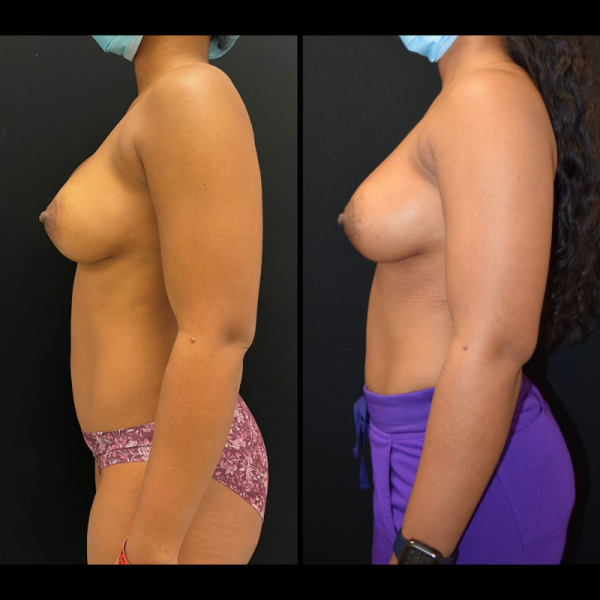 capsular-contracture-breast-implant-revision-plastic-surgery-nyc-before-after-ak-patient-1-5