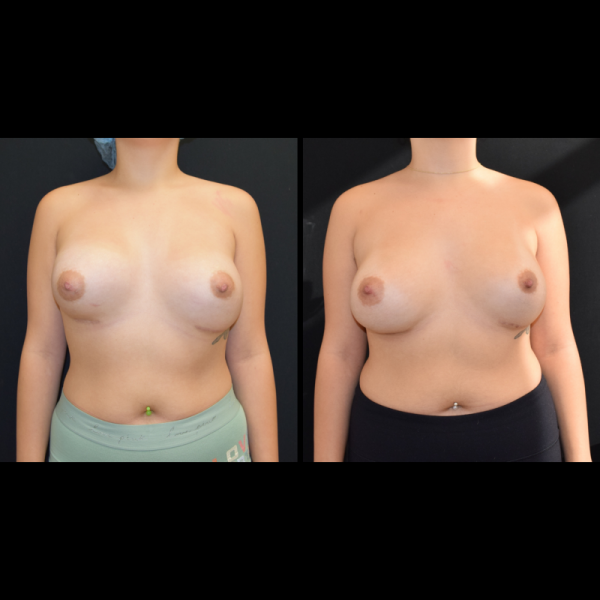 capsular-contracture-breast-implant-revision-plastic-surgery-nyc-before-after-hj-patient-1-1