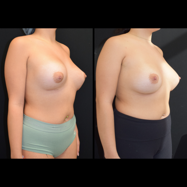 capsular-contracture-breast-implant-revision-plastic-surgery-nyc-before-after-hj-patient-1-2