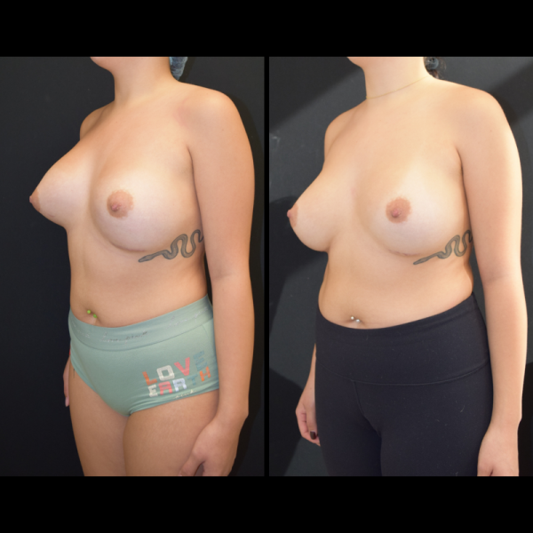 capsular-contracture-breast-implant-revision-plastic-surgery-nyc-before-after-hj-patient-1-3