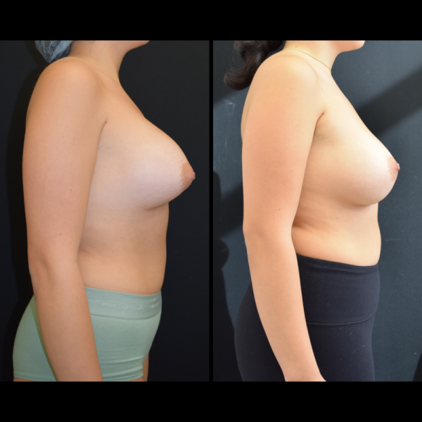 capsular-contracture-breast-implant-revision-plastic-surgery-nyc-before-after-hj-patient-1-4