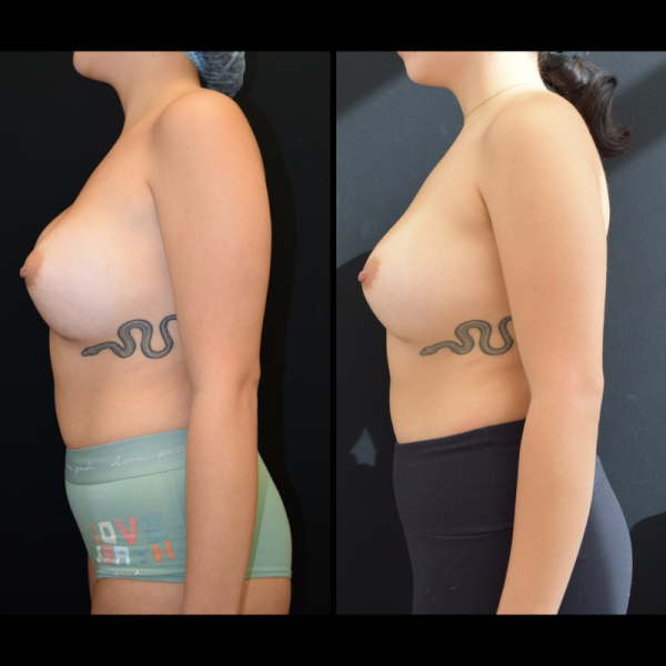 capsular-contracture-breast-implant-revision-plastic-surgery-nyc-before-after-hj-patient-1-5