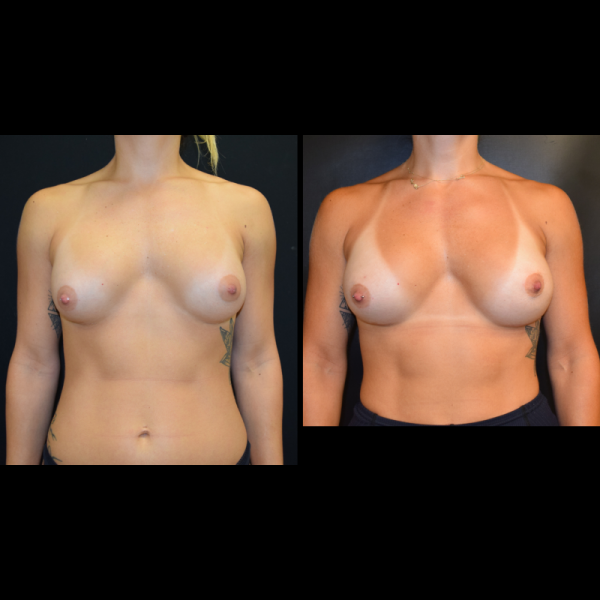 capsular-contracture-breast-implant-revision-plastic-surgery-nyc-before-after-le-patient-1-1