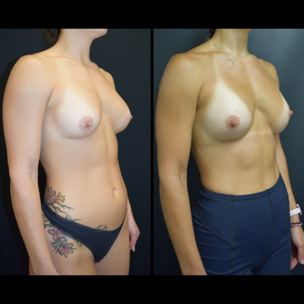capsular-contracture-breast-implant-revision-plastic-surgery-nyc-before-after-le-patient-1-2