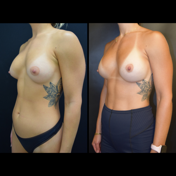 capsular-contracture-breast-implant-revision-plastic-surgery-nyc-before-after-le-patient-1-3