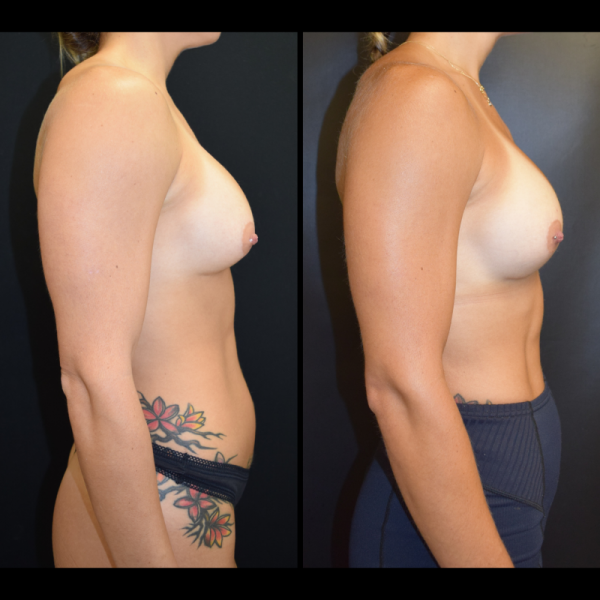 capsular-contracture-breast-implant-revision-plastic-surgery-nyc-before-after-le-patient-1-4